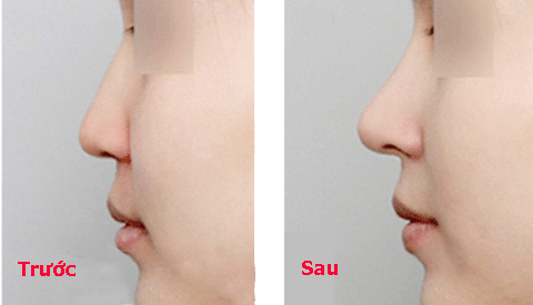 kết quả nâng mũi không phẫu thuật